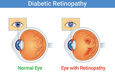 Diabetic Retinopathy: Symptoms, Causes, & Treatment Options