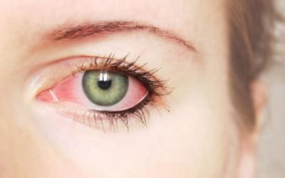 What is Ocular Rosacea? Learn the Symptoms, Causes and Get Treated